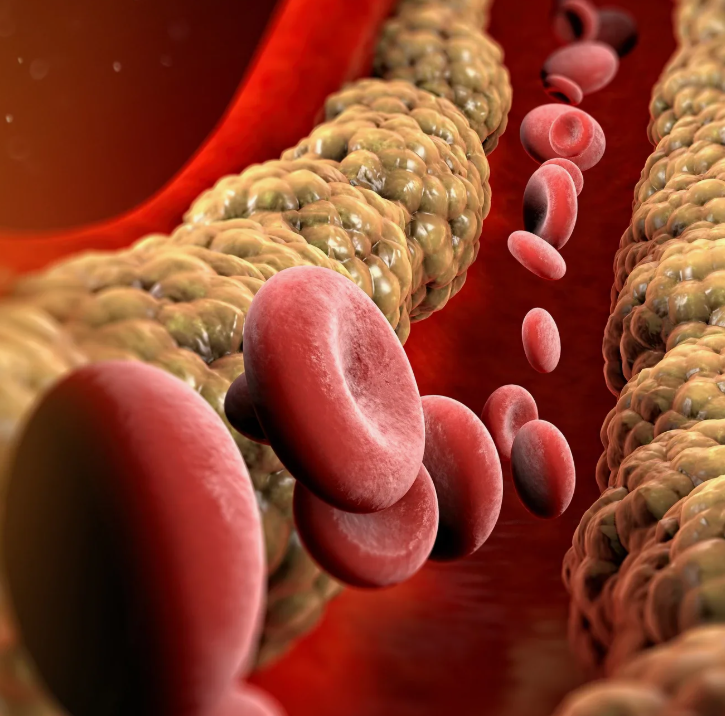 Холестерин и механизм образования бляшек