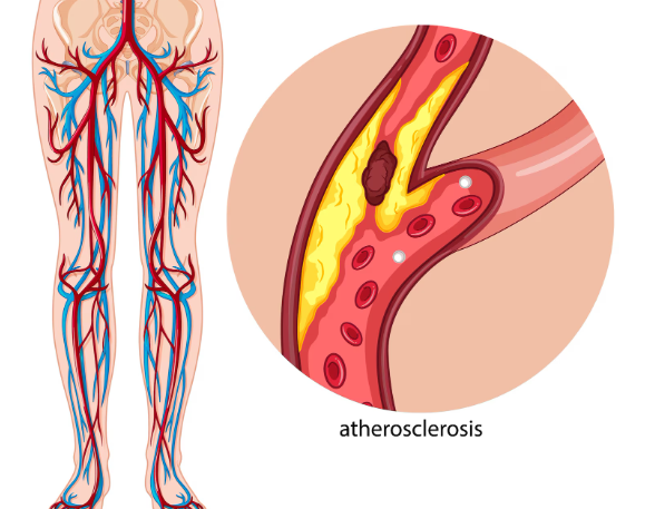 Как появляются атеросклеротические бляшки при повышенном холестерине